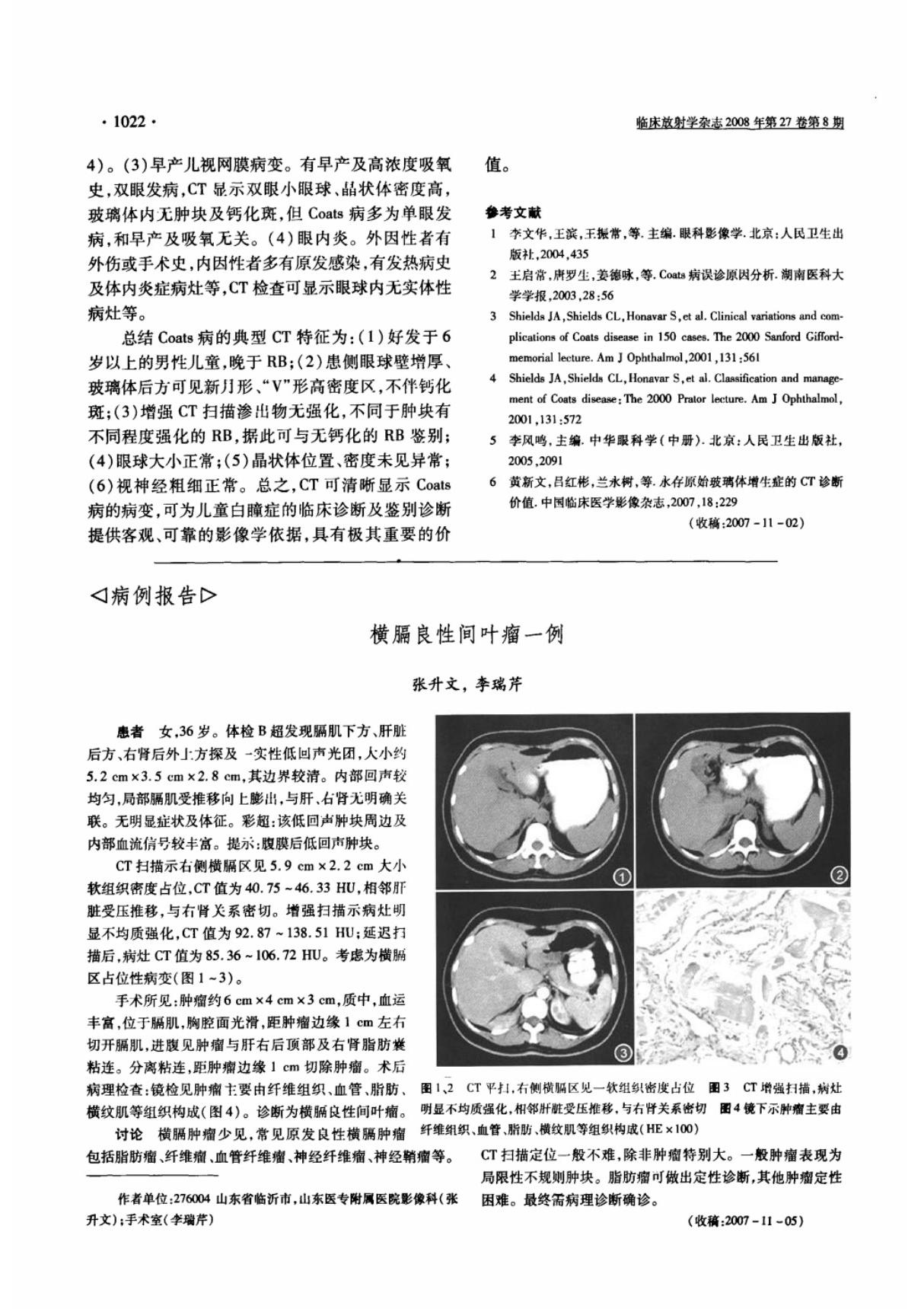 横膈良性间叶瘤一例