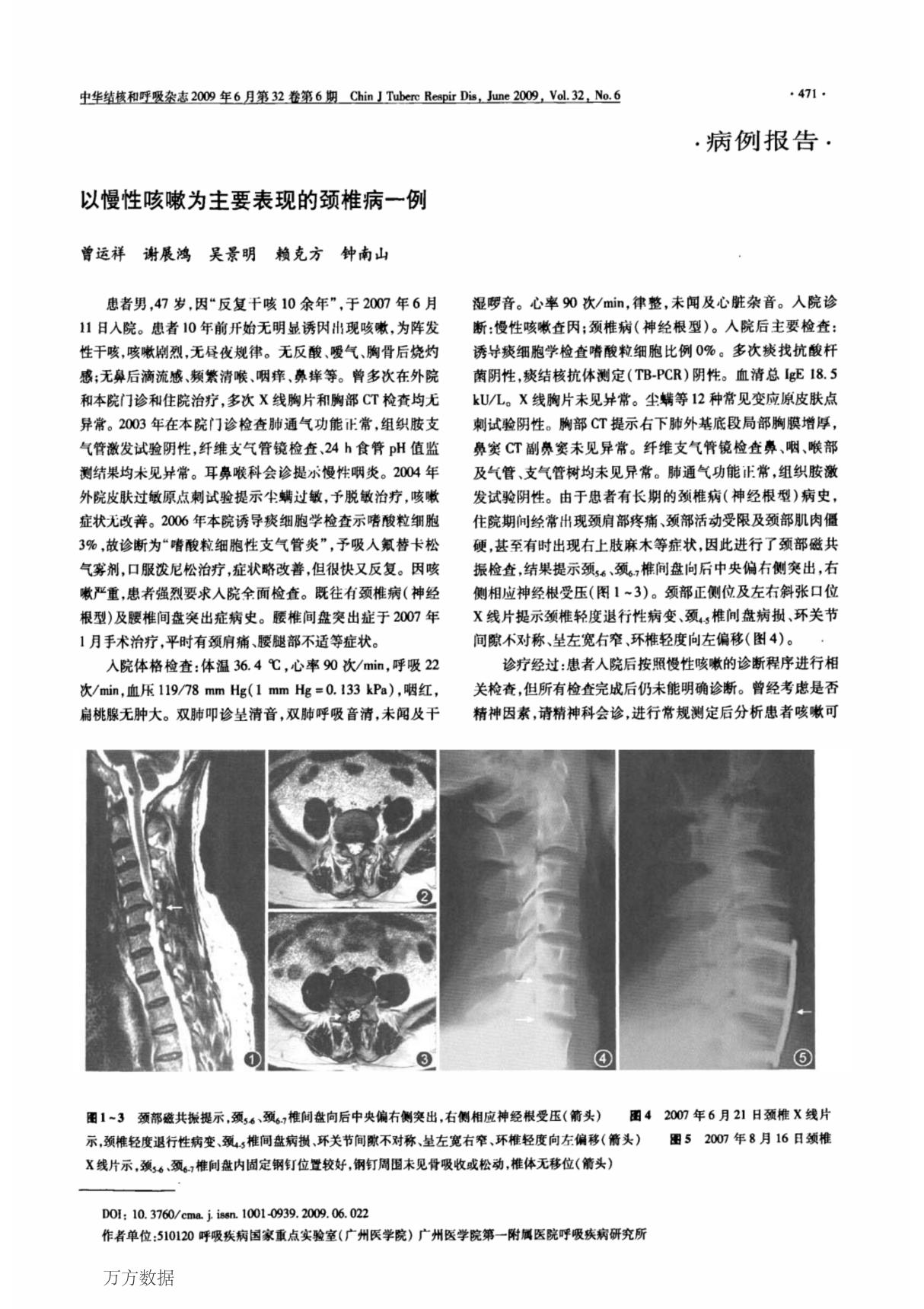 以慢性咳嗽为主要表现的颈椎病一例