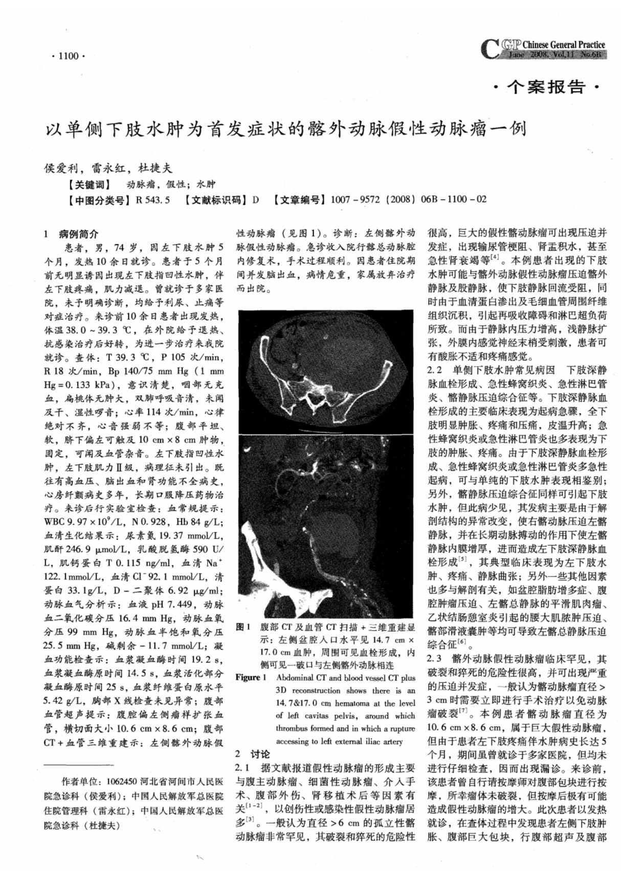 以单侧下肢水肿为首发症状的髂外动脉假性动脉瘤一例