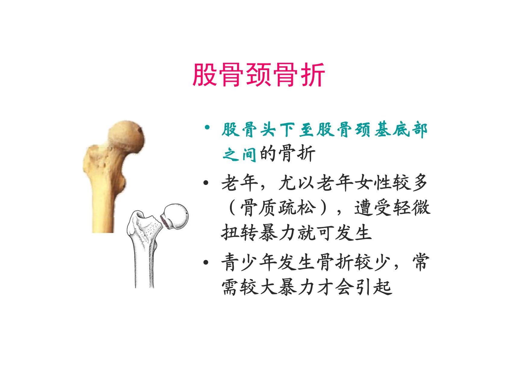 股骨颈骨折-PPT(精)