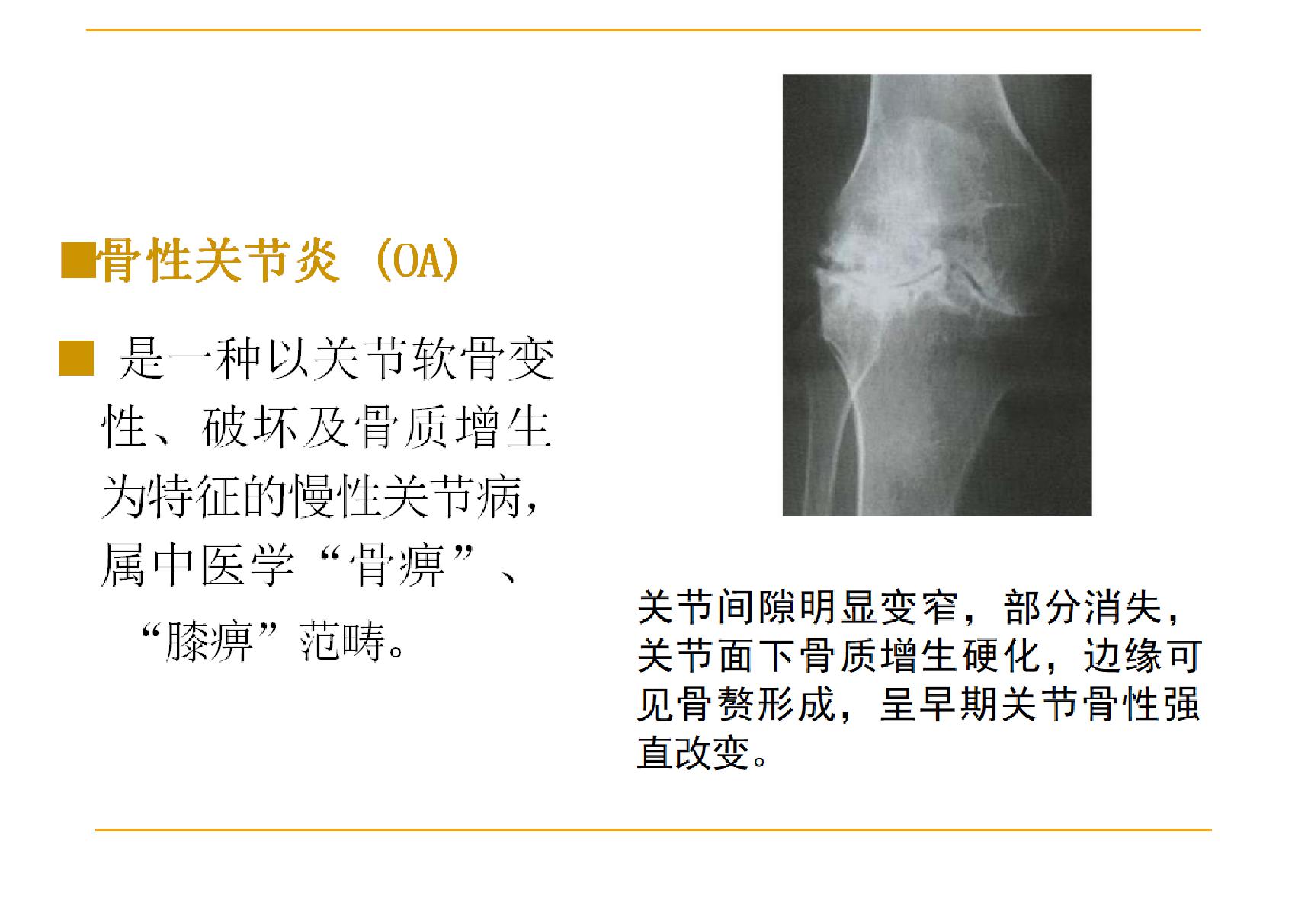 骨性关节炎ppt课件