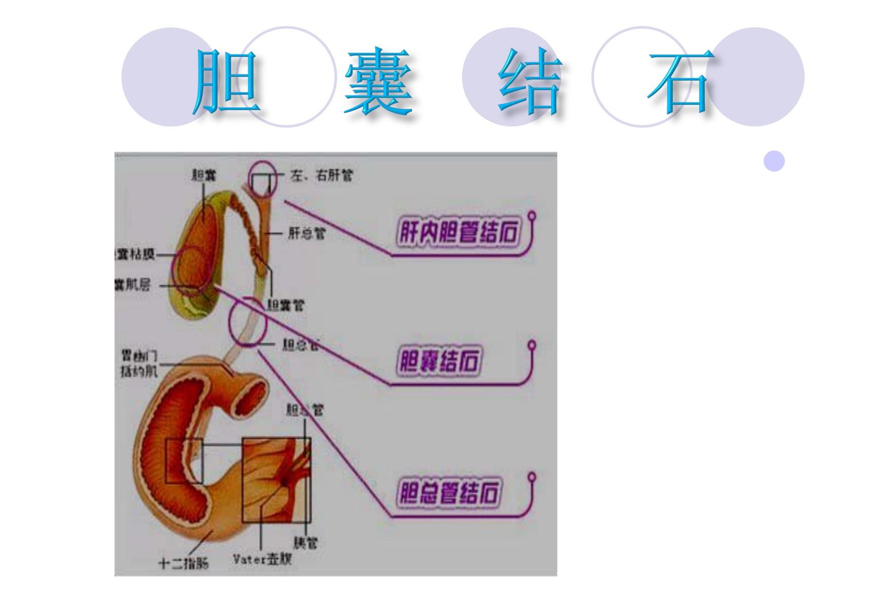 胆囊结石护理