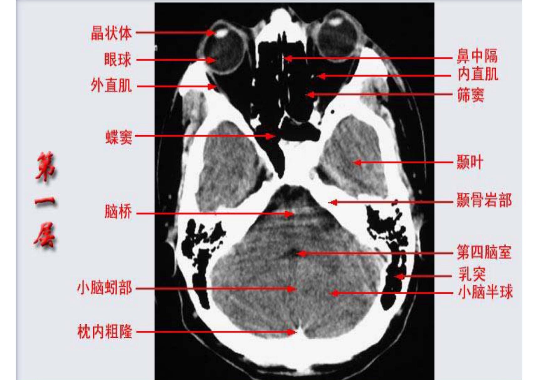 头颅ct解剖-PPT(精)